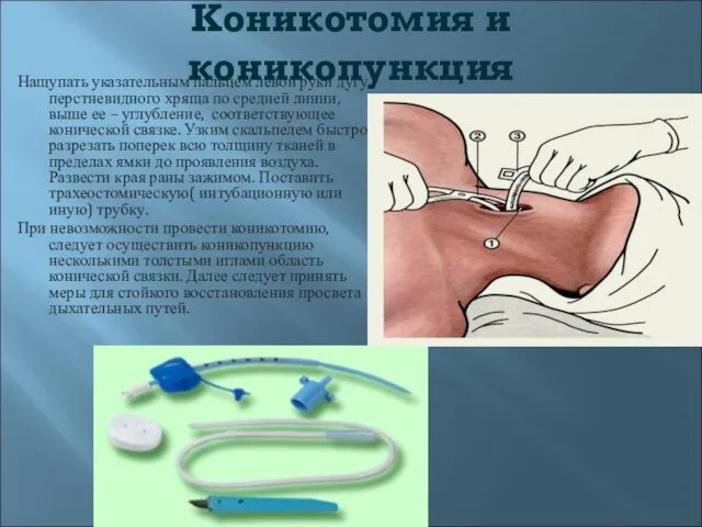 Коникотомия и коникопункция Нащупать указательным пальцем левой руки дугу перстневидного хряща