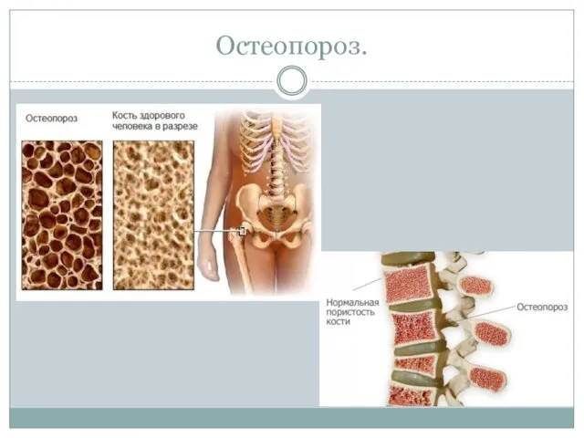 Остеопороз.