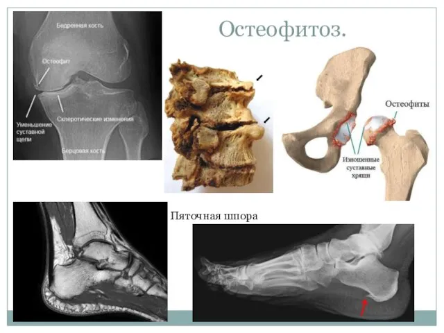 Остеофитоз. Пяточная шпора