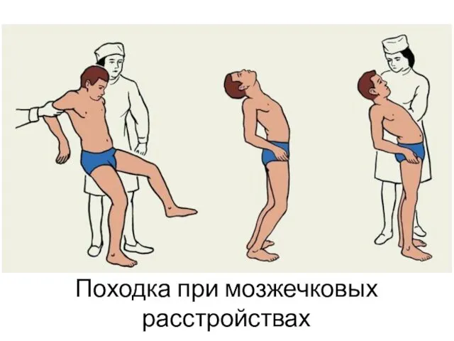 Походка при мозжечковых расстройствах