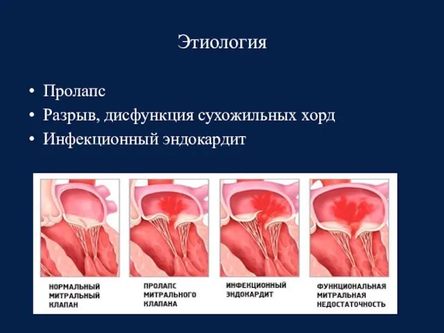 Этиология Пролапс Разрыв, дисфункция сухожильных хорд Инфекционный эндокардит