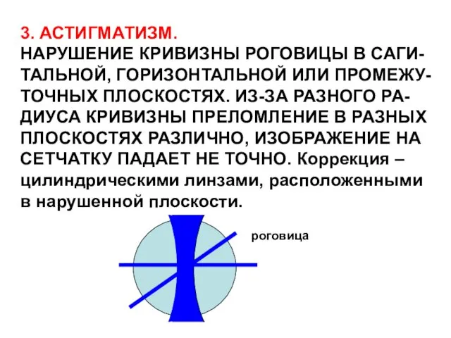 3. АСТИГМАТИЗМ. НАРУШЕНИЕ КРИВИЗНЫ РОГОВИЦЫ В САГИ- ТАЛЬНОЙ, ГОРИЗОНТАЛЬНОЙ ИЛИ ПРОМЕЖУ-