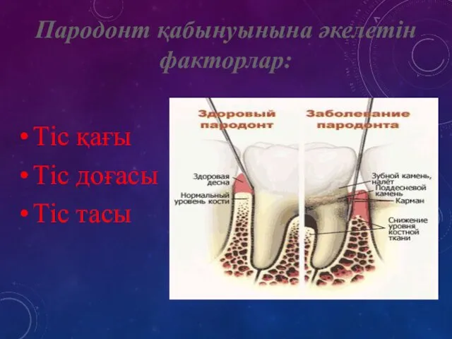 Пародонт қабынуынына әкелетін факторлар: Тіс қағы Тіс доғасы Тіс тасы