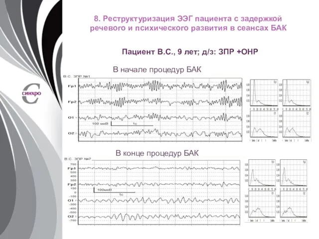 8. Реструктуризация ЭЭГ пациента с задержкой речевого и психического развития в