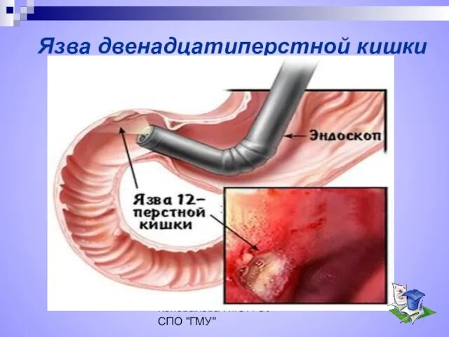 Коновалова Н.Ю. ГОУ СПО "ГМУ" Язва двенадцатиперстной кишки