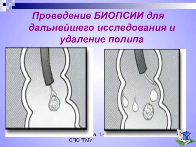 Коновалова Н.Ю. ГОУ СПО "ГМУ" Проведение БИОПСИИ для дальнейшего исследования и удаление полипа