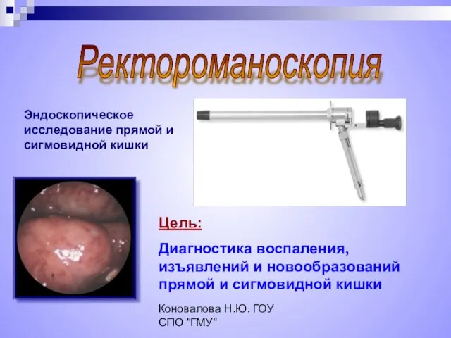 Коновалова Н.Ю. ГОУ СПО "ГМУ" Ректороманоскопия Цель: Диагностика воспаления, изъявлений и