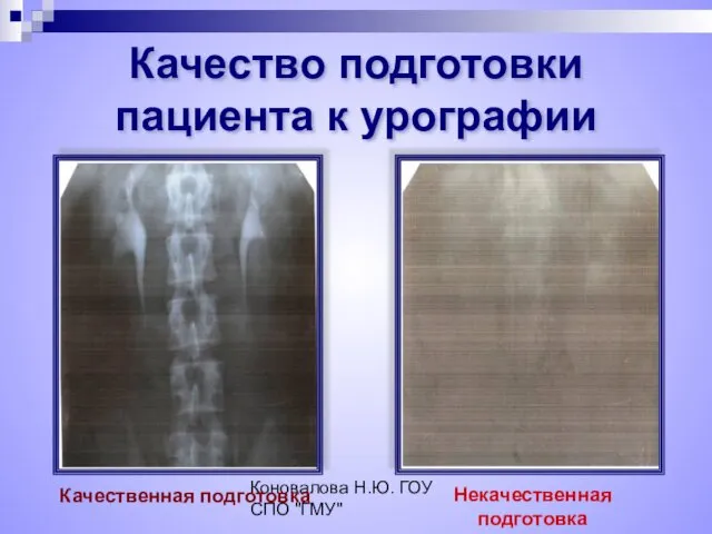 Коновалова Н.Ю. ГОУ СПО "ГМУ" Качество подготовки пациента к урографии Качественная подготовка Некачественная подготовка