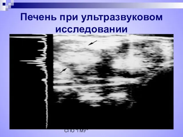 Коновалова Н.Ю. ГОУ СПО "ГМУ" Печень при ультразвуковом исследовании