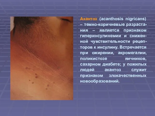 Акантоз (acanthosis nigricans) – темно-коричневые разраста-ния – является признаком гиперинсулинемии и