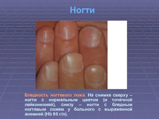 Ногти Бледность ногтевого ложа. На снимке сверху – ногти с нормальным