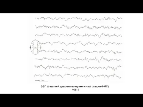 ЭЭГ 11-летней девочки во время сна (I стадия ФМС) - POSTS