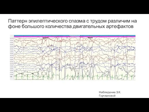 Паттерн эпилептического спазма с трудом различим на фоне большого количества двигательных артефактов Наблюдение З.К. Горчхановой