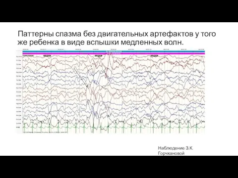 Паттерны спазма без двигательных артефактов у того же ребенка в виде