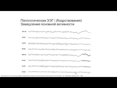 Патологическая ЭЭГ I (бодрствование) Замедление основной активности Полякова В.Б. Атлас электроэнцефалограмм