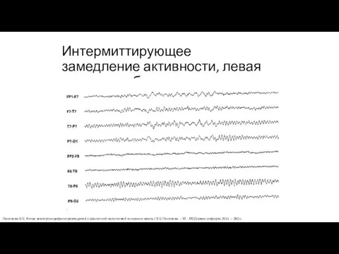 Интермиттирующее замедление активности, левая височная область Полякова В.Б. Атлас электроэнцефалограмм детей