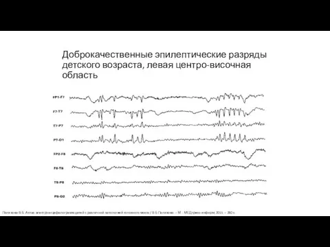 Доброкачественные эпилептические разряды детского возраста, левая центро-височная область Полякова В.Б. Атлас