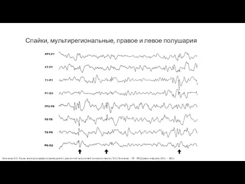 Спайки, мультирегиональные, правое и левое полушария Полякова В.Б. Атлас электроэнцефалограмм детей