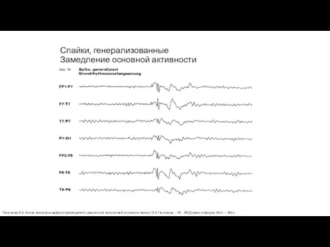 Спайки, генерализованные Замедление основной активности Полякова В.Б. Атлас электроэнцефалограмм детей с