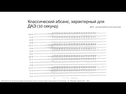 Классический абсанс, характерный для ДАЭ (10 секунд) ДАЭ – детская абсансная