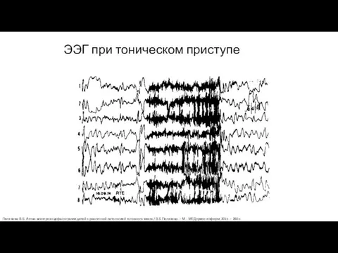 ЭЭГ при тоническом приступе Полякова В.Б. Атлас электроэнцефалограмм детей с различной