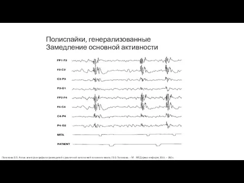 Полиспайки, генерализованные Замедление основной активности Полякова В.Б. Атлас электроэнцефалограмм детей с