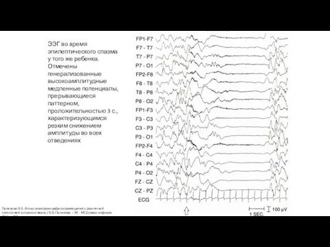 ЭЭГ во время эпилептического спазма у того же ребенка. Отмечены генерализованные