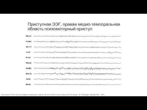 Приступная ЭЭГ, правая медио-темпоральная область психомоторный приступ Полякова В.Б. Атлас электроэнцефалограмм