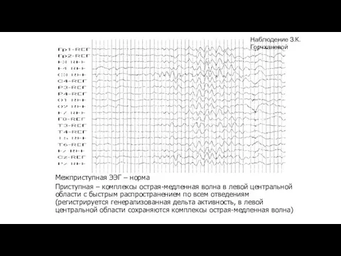 Межприступная ЭЭГ – норма Приступная – комплексы острая-медленная волна в левой