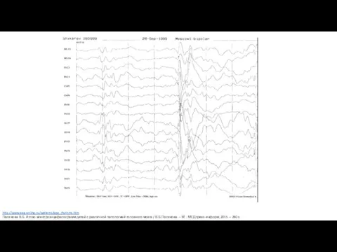 http://www.eeg-online.ru/patterns/eeg_rhythms.htm Полякова В.Б. Атлас электроэнцефалограмм детей с различной патологией головного мозга