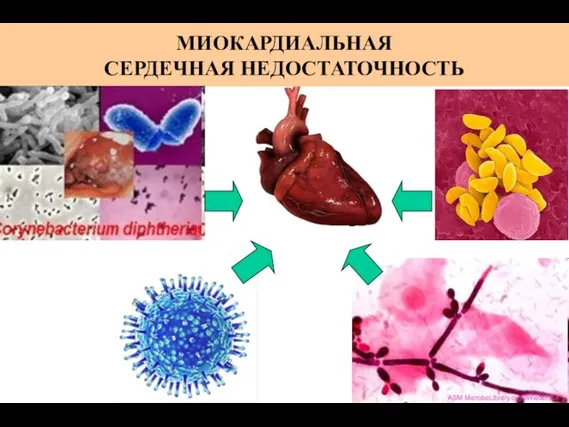 МИОКАРДИАЛЬНАЯ СЕРДЕЧНАЯ НЕДОСТАТОЧНОСТЬ