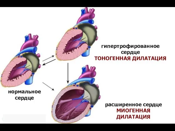 нормальное сердце гипертрофированное сердце ТОНОГЕННАЯ ДИЛАТАЦИЯ расширенное сердце МИОГЕННАЯ ДИЛАТАЦИЯ