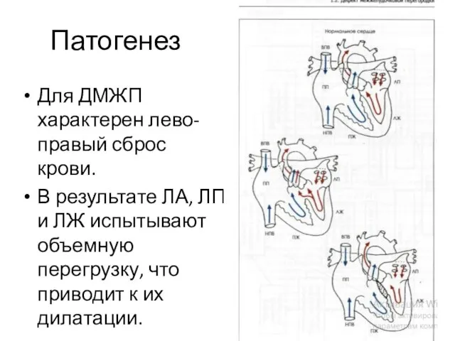 Патогенез Для ДМЖП характерен лево-правый сброс крови. В результате ЛА, ЛП