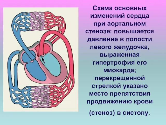 Схема основных изменений сердца при аортальном стенозе: повышается давление в полости