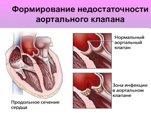 Формирование недостаточности аортального клапана