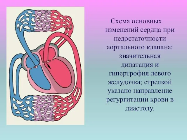 Схема основных изменений сердца при недостаточности аортального клапана: значительная дилатация и