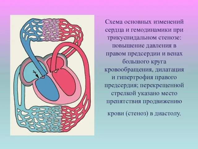 Схема основных изменений сердца и гемодинамики при трикуспидальном стенозе:повышение давления в