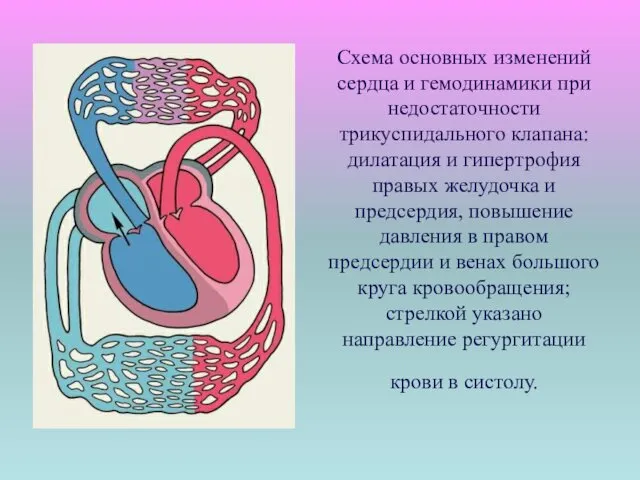 Схема основных изменений сердца и гемодинамики при недостаточности трикуспидального клапана:дилатация и