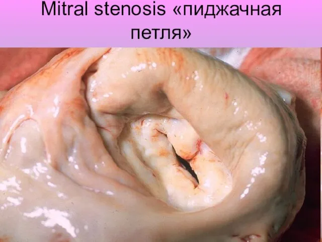 Mitral stenosis «пиджачная петля»