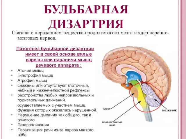 БУЛЬБАРНАЯ ДИЗАРТРИЯ Связана с поражением вещества продолговатого мозга и ядер черепно-мозговых