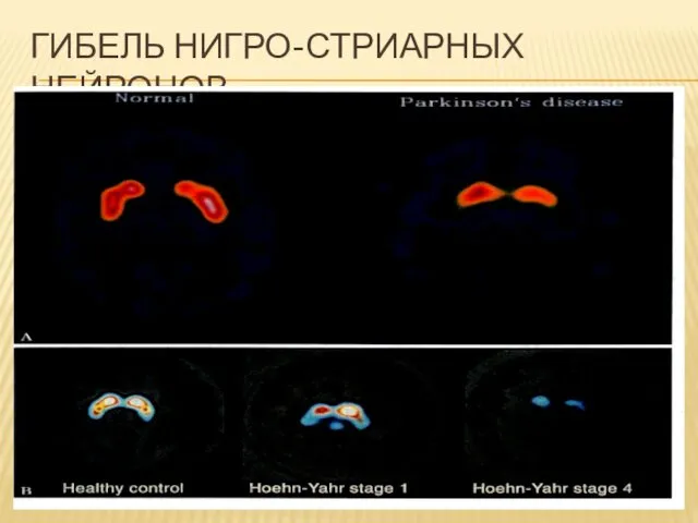 ГИБЕЛЬ НИГРО-СТРИАРНЫХ НЕЙРОНОВ