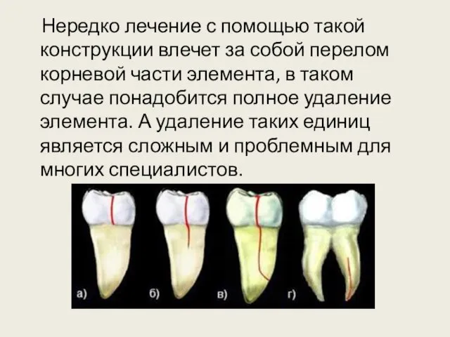 Нередко лечение с помощью такой конструкции влечет за собой перелом корневой