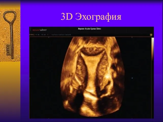 3D Эхография