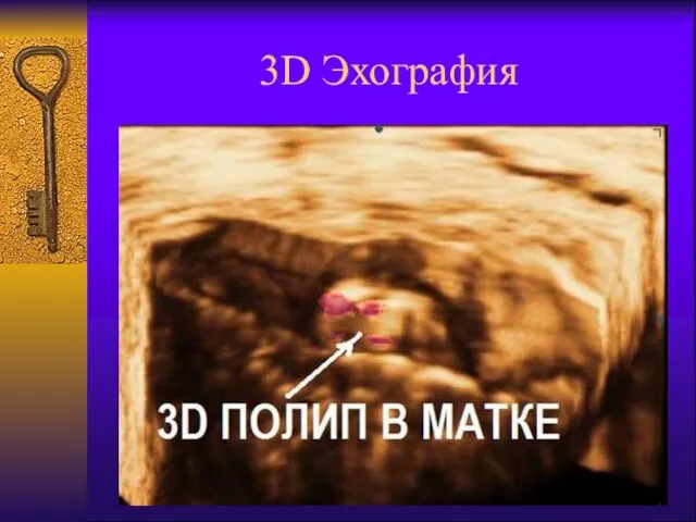 3D Эхография