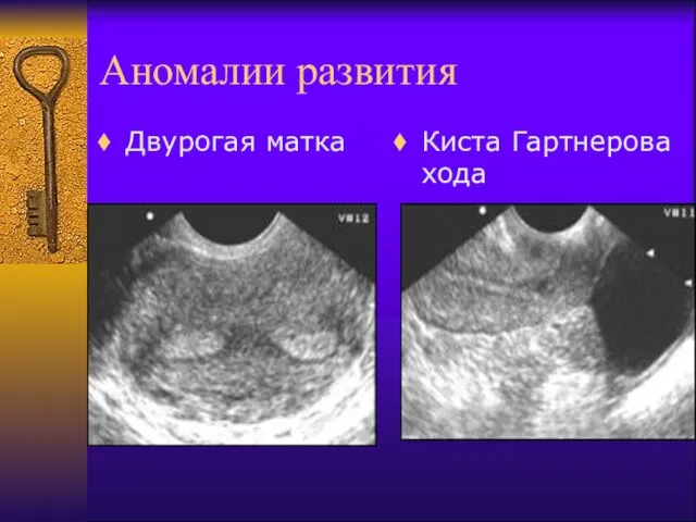 Аномалии развития Двурогая матка Киста Гартнерова хода