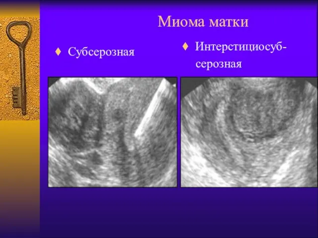 Миома матки Субсерозная Интерстициосуб- серозная