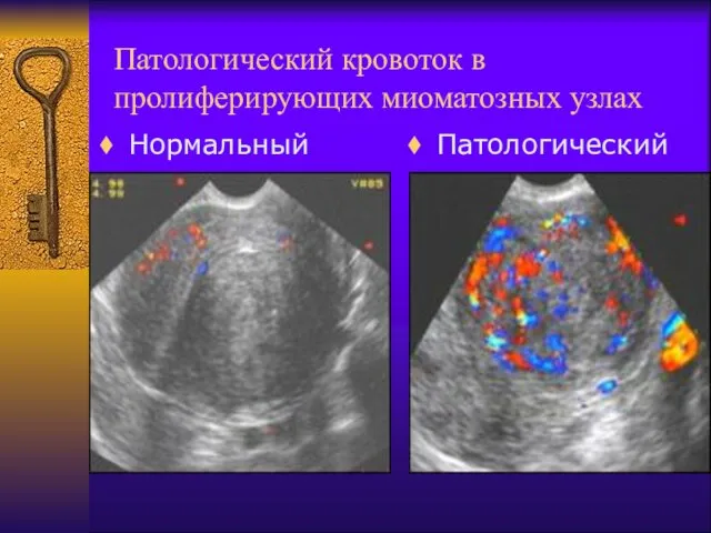 Патологический кровоток в пролиферирующих миоматозных узлах Нормальный Патологический