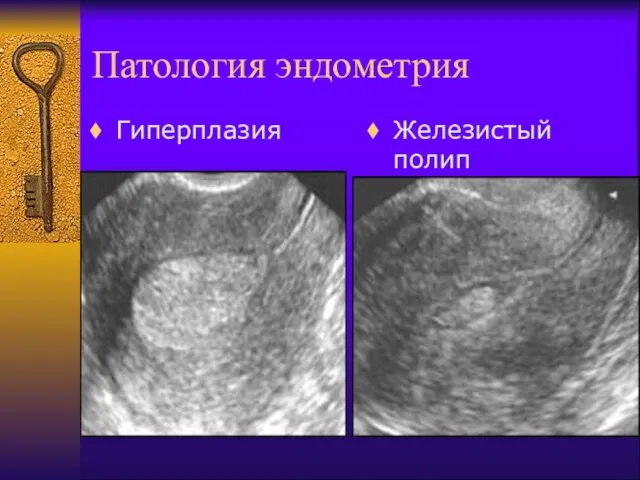 Патология эндометрия Гиперплазия Железистый полип Железистый полип Железистый полип Железистый полип