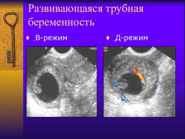 Развивающаяся трубная беременность В-режим Д-режим