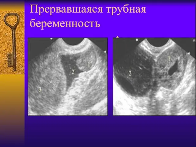 Прервавшаяся трубная беременность